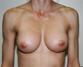 Feel Beautiful - Breast Revision San Diego 6 - After Photo